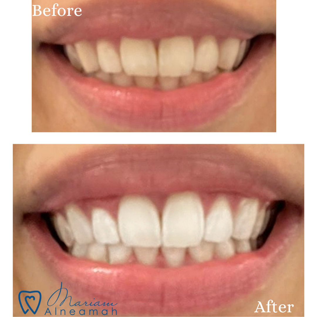 Before and after whitening result