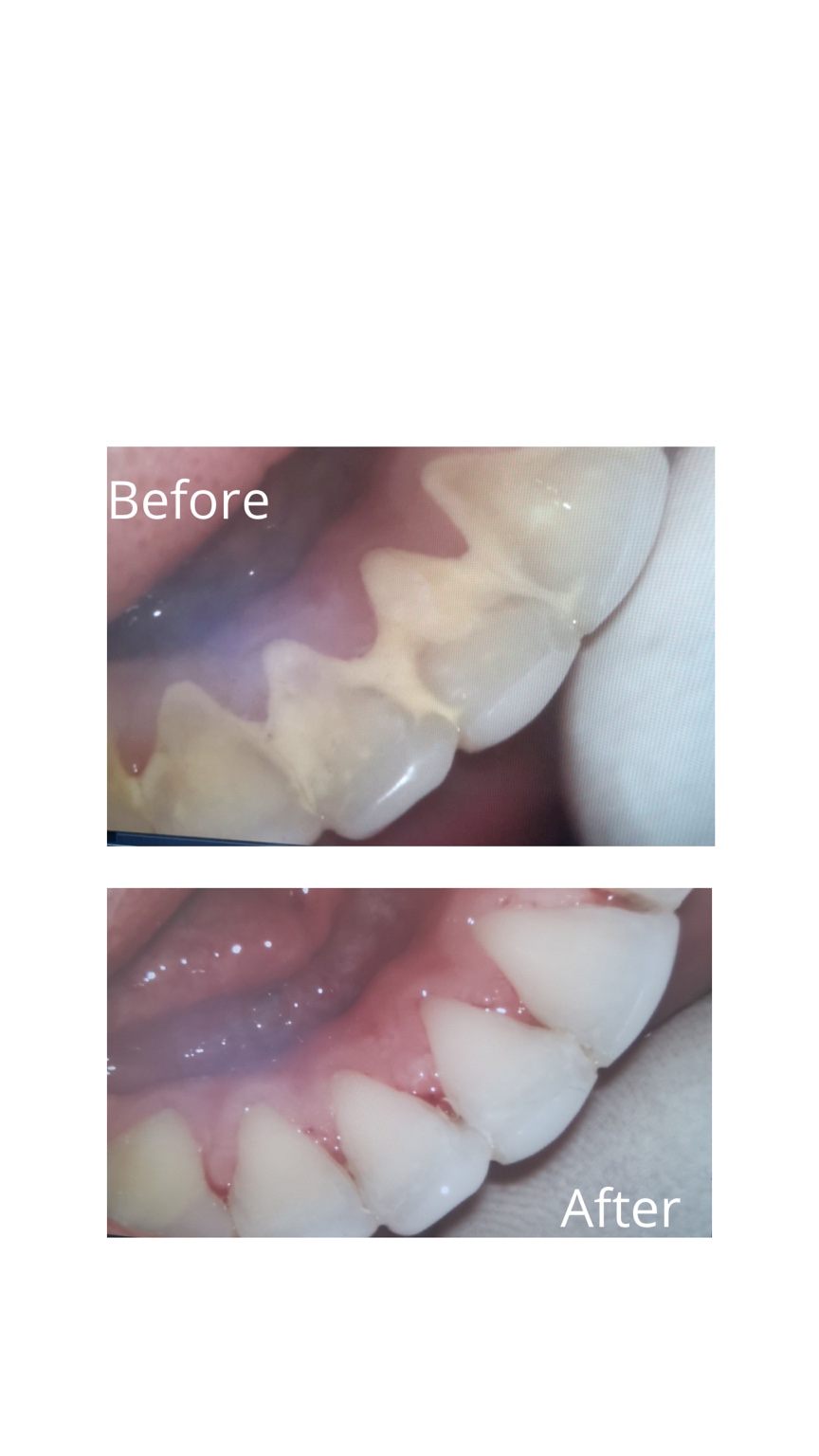 Before and after cleaning result