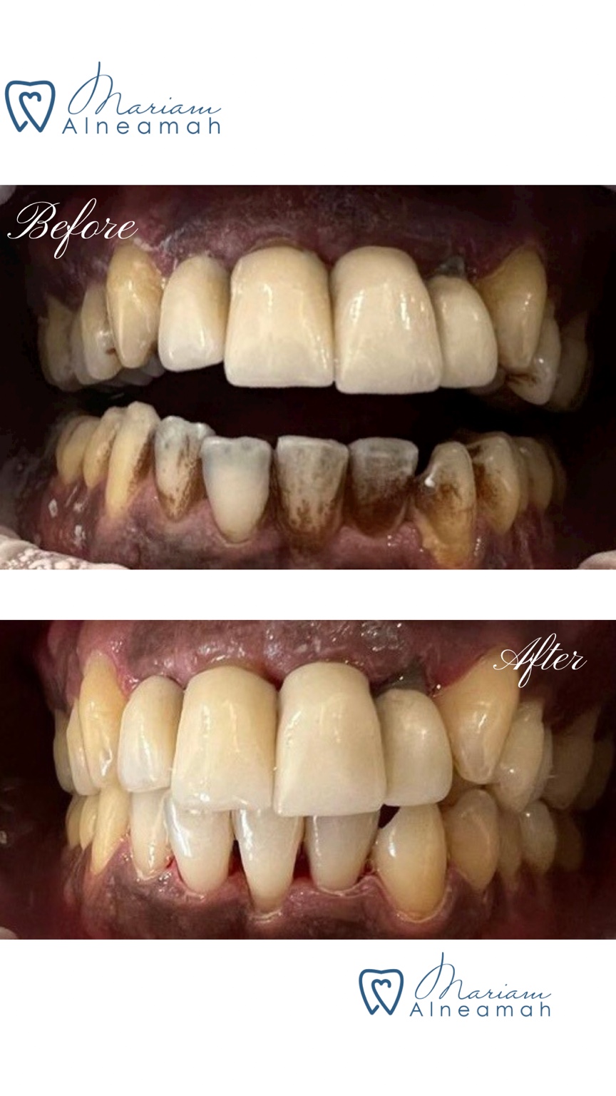 Before and after cleaning result