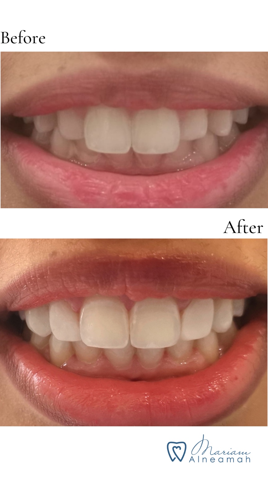 Before and after whitening result