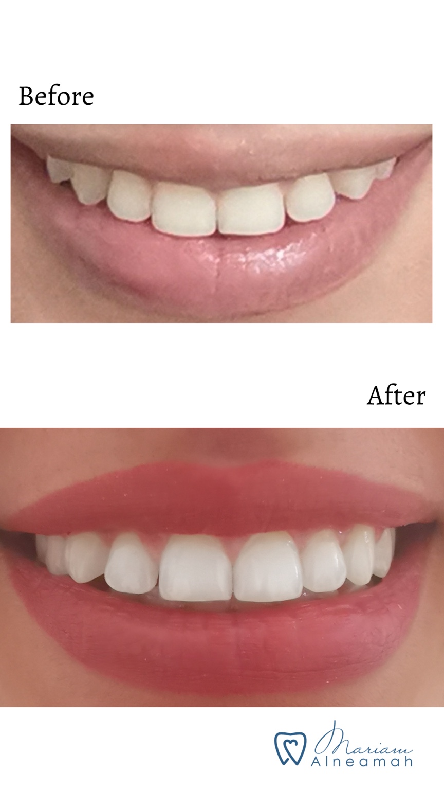 Before and after whitening result