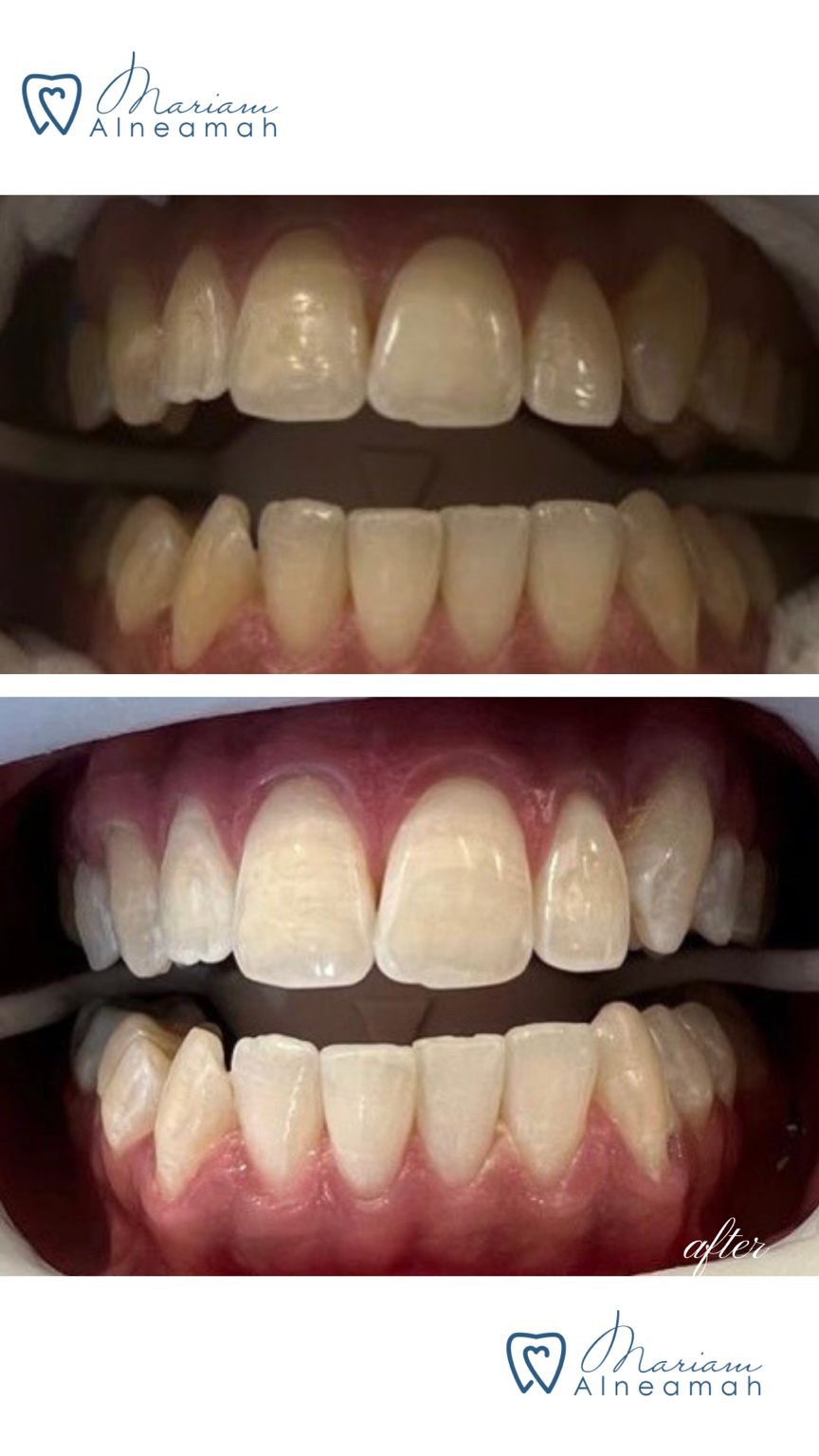 Before and after whitening result