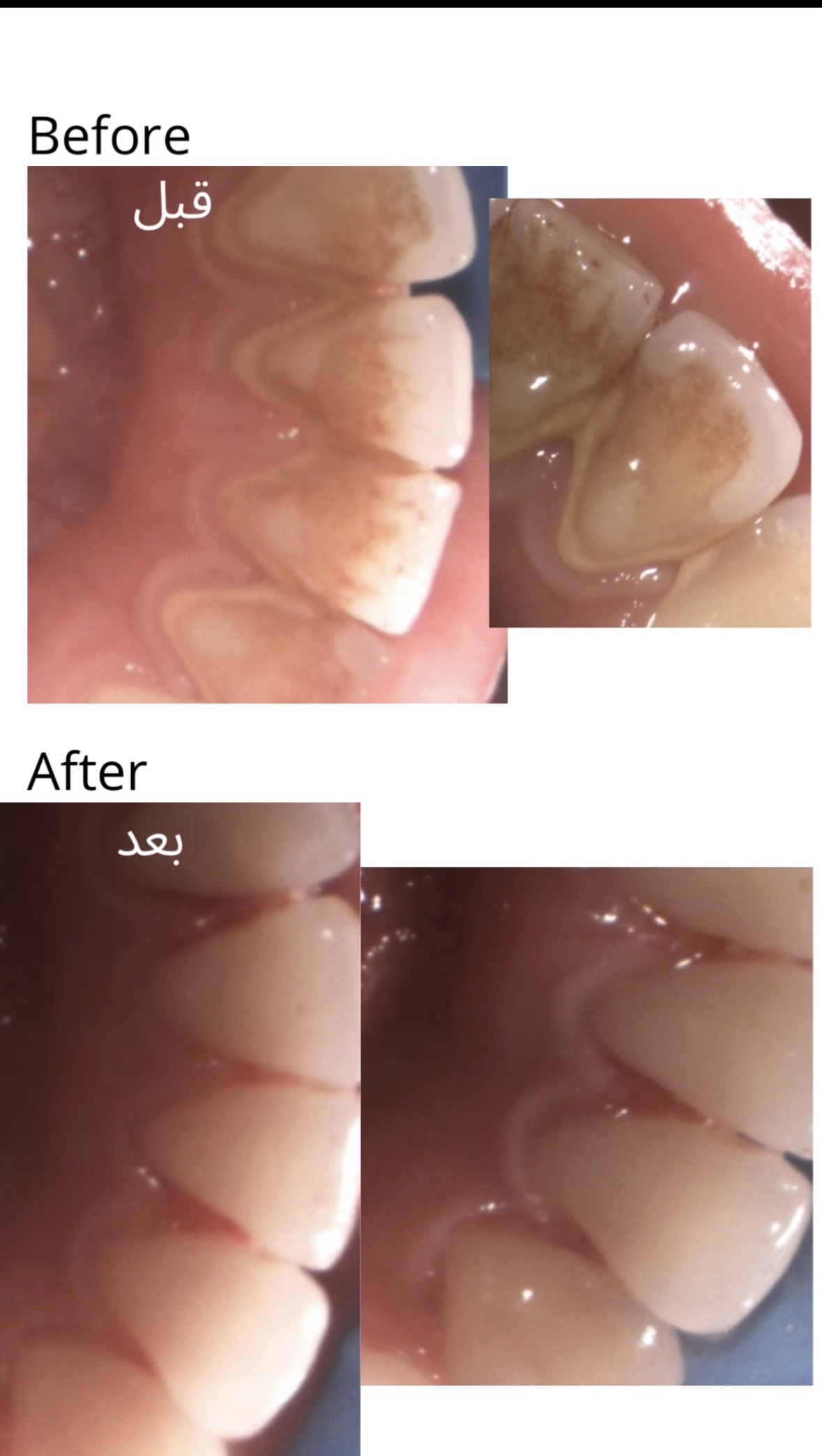 Before and after cleaning result