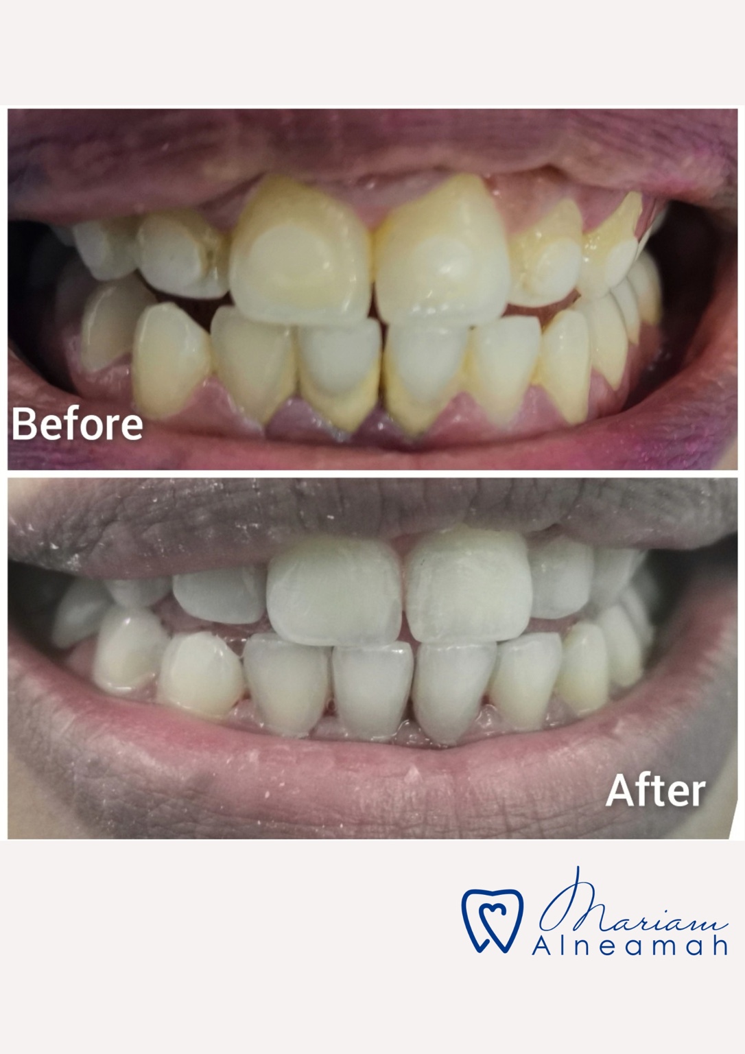 Before and after cleaning result