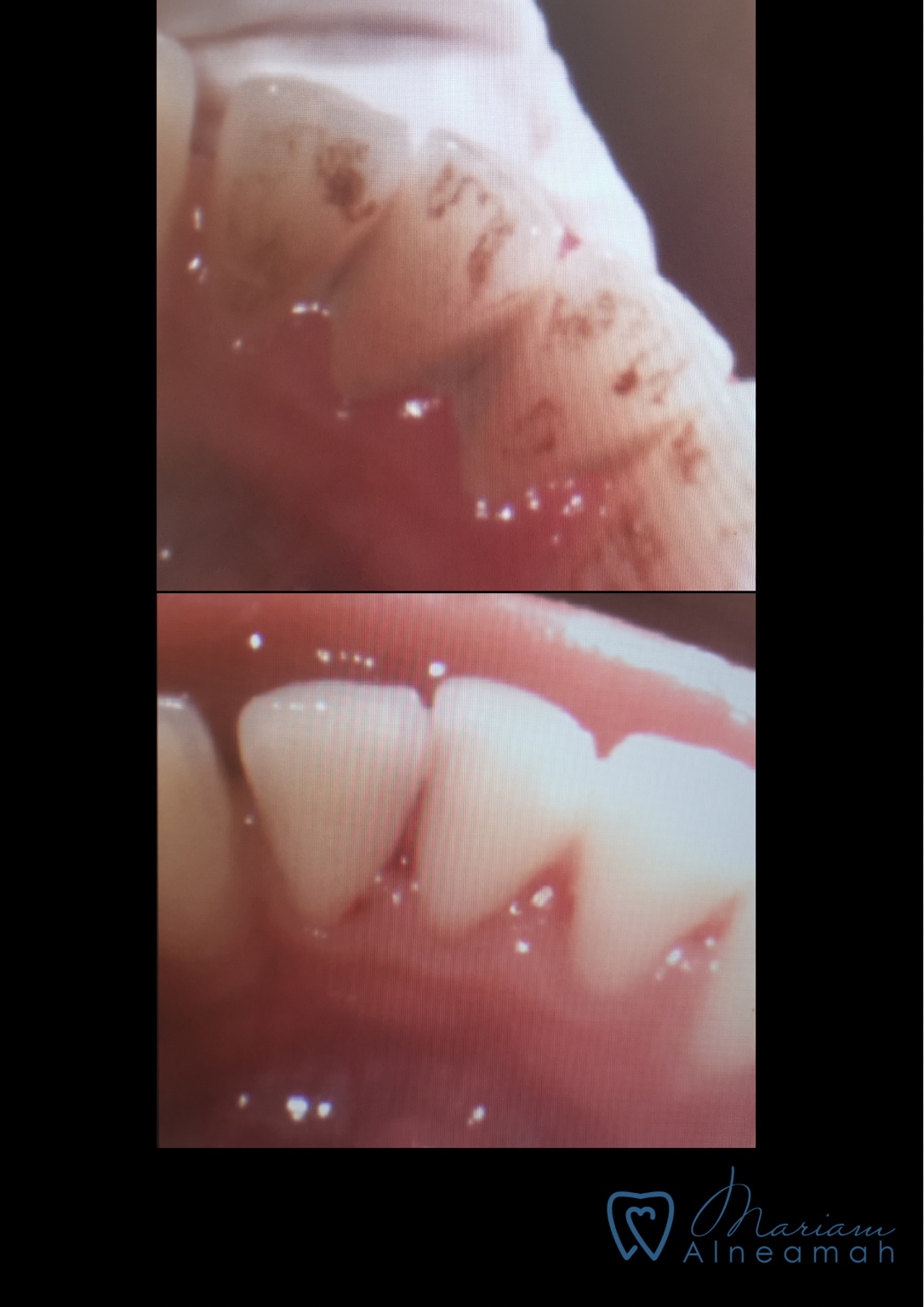 Before and after cleaning result