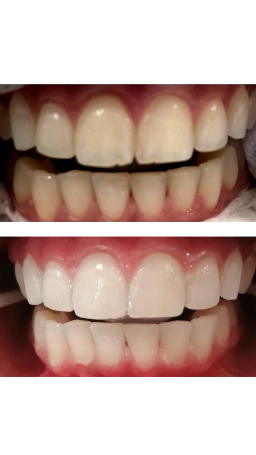 Before and after whitening result